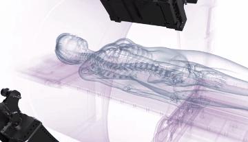 放疗新技术tomo治疗,tomo放疗技术可以根治肿瘤吗