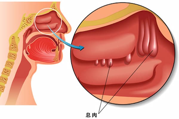 【低温等离子消融术】快速解决鼻息肉困扰，让呼吸更畅快！-潍坊耳鼻喉医院