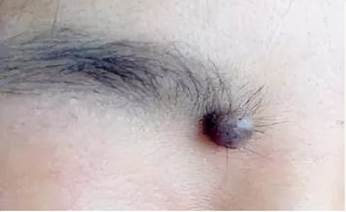 人各有“痣”，长在这些部位的痣易癌变！ABCDE法自测危险程度