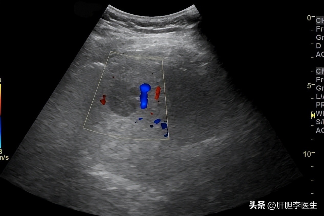 肝硬化低回声结节是肝癌几率高吗,肝癌是低回声还是高回声