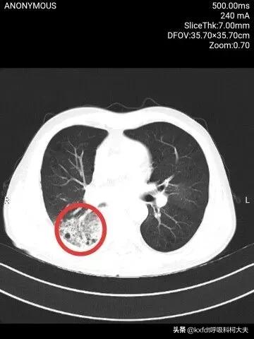 肺癌一定会有什么表现,肺癌可引起哪些并发症