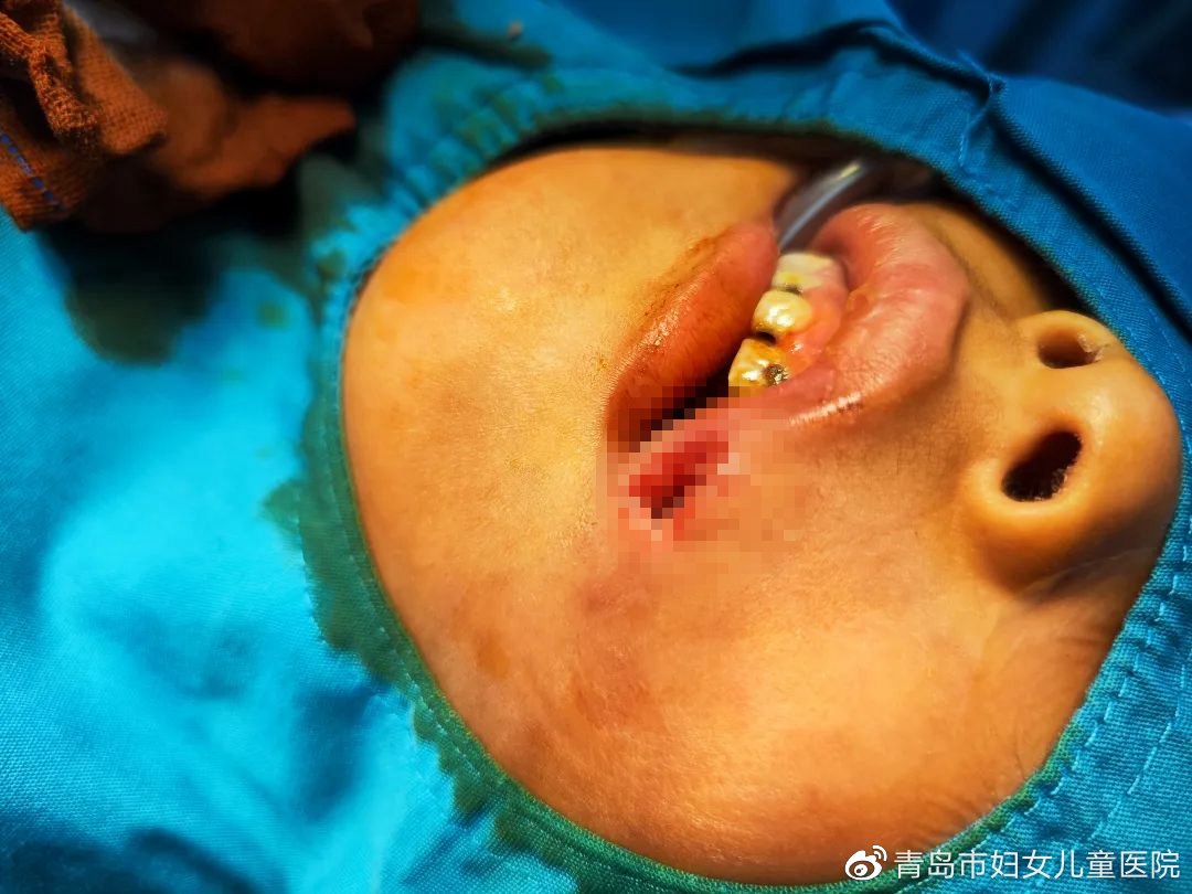 孩子淘气磕破了嘴巴怎么好得快,宝宝嘴巴摔破一厘米