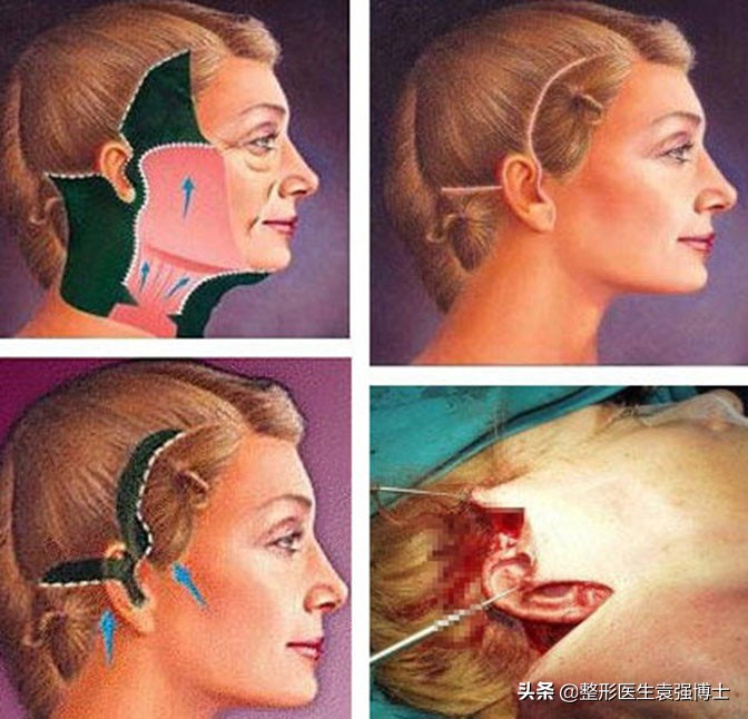 做完线雕不戴头套感觉撕拉痛,做完线雕为什么不能嚼硬东西