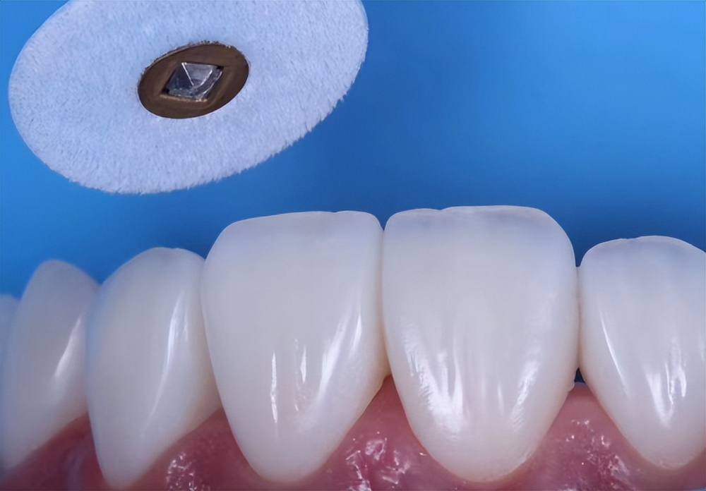 不同瓷块的贴面,不同瓷贴面的对比图