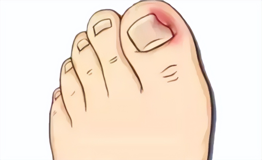 一走路脚指甲里疼怎么回事,一走路脚趾骨疼痛是什么原因呢