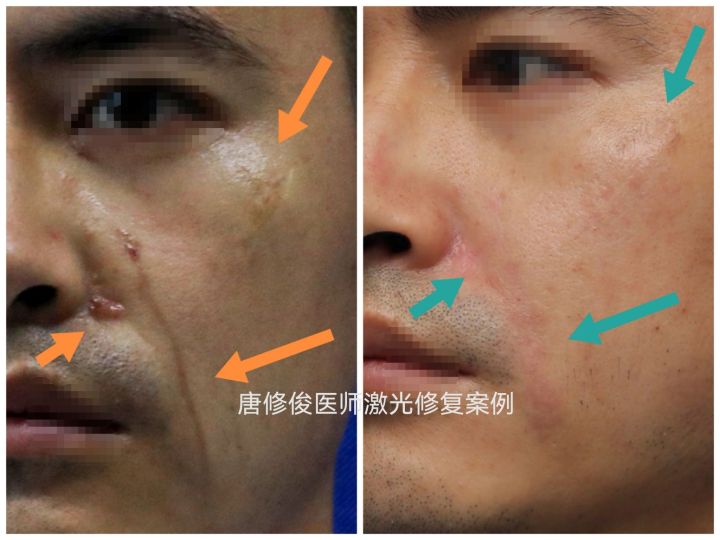 伤口做点阵激光治疗,点阵激光后怎么清理伤口