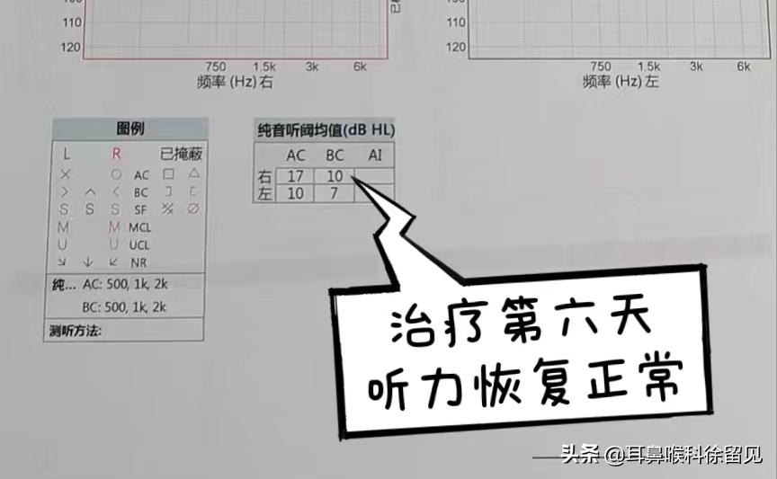 年轻女孩K歌后患上突发性耳聋,花了1周的时间做治疗