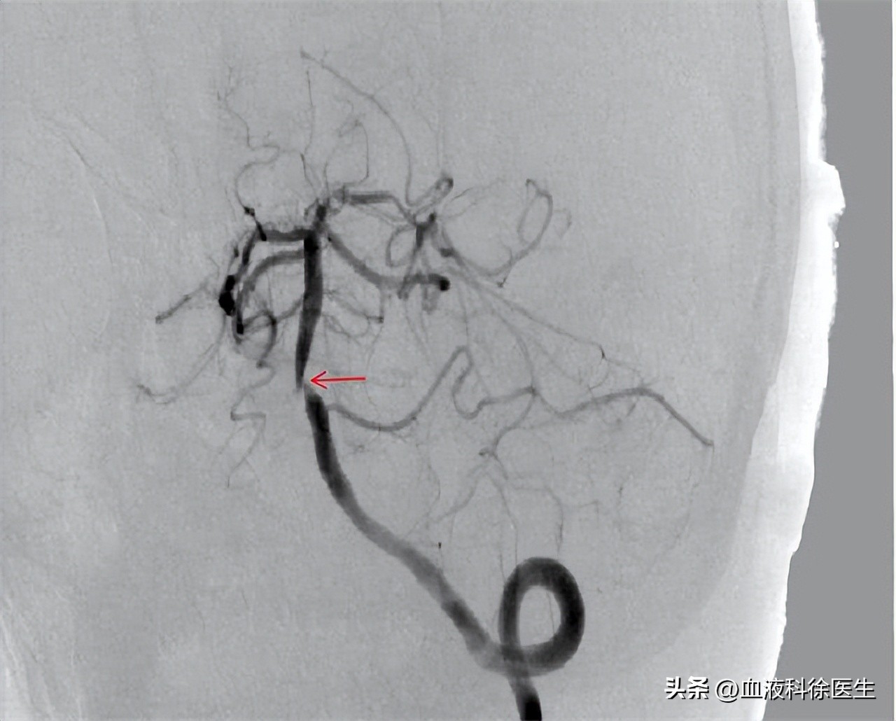 为什么脑血栓都是赌博惹的祸,为什么得了脑血栓会反复发高烧