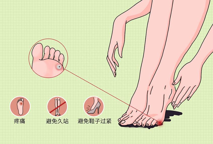 脚上长了类似瘊子又像老茧的东西,长在脚上的鸡眼和疣的区别