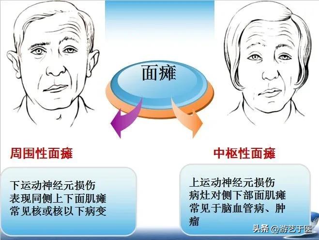 耳朵后面痛是要面瘫了吗,出现耳后疼痛小心是面瘫