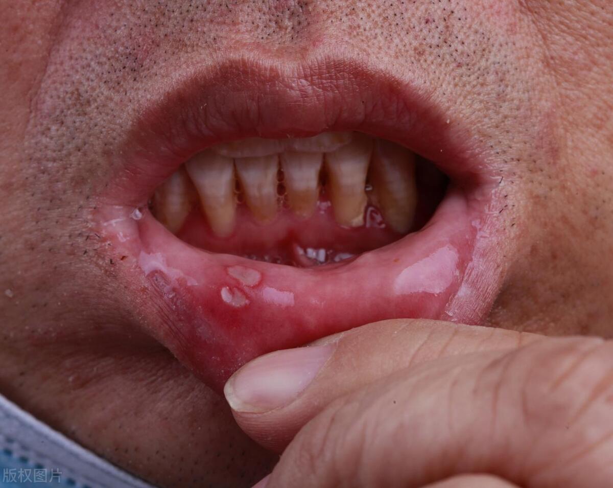 口腔癌症的初期症状和危害,口腔癌症的初期表现症状是什么