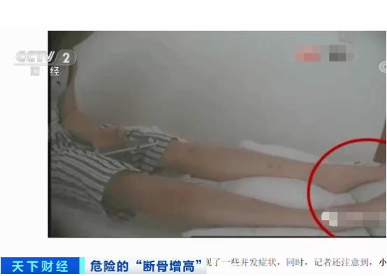 李亚诺断骨手术,断骨增高7.2厘米的李亚诺现状