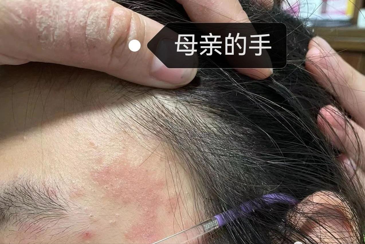 面部皮炎的症状和治疗方法,面部皮炎是怎么回事