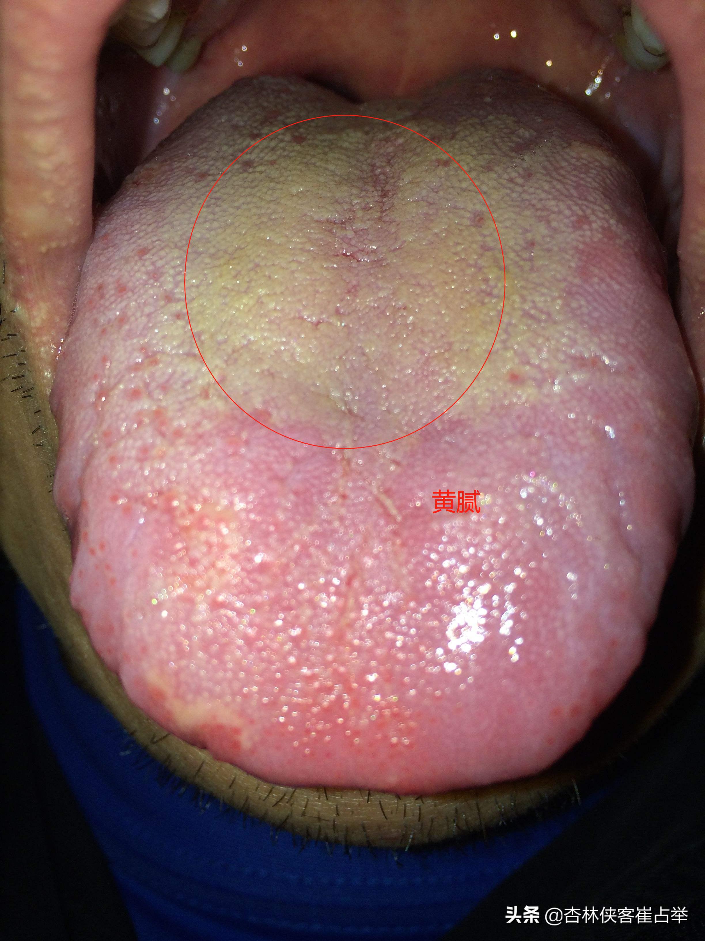 胃火旺最快的下火方法中医,胃火旺什么中药调理