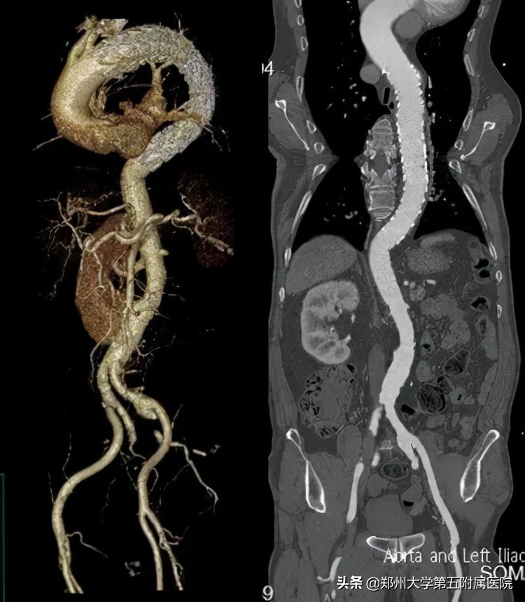 主动脉夹层血肿不消是怎么回事,主动脉壁间血肿血压不稳定