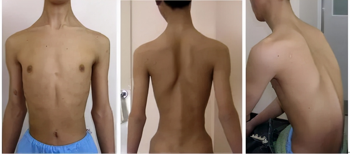 患有进行性肌营养不良症,进行性肌营养不良症一般几岁发病