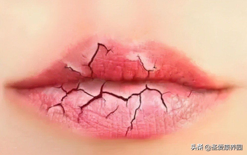 嘴唇越舔越容易干裂怎么办,嘴唇越舔越干用什么药