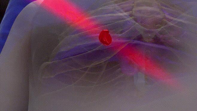 肺癌早期做射波刀,咳嗽有痰做体检查出肺癌严重不