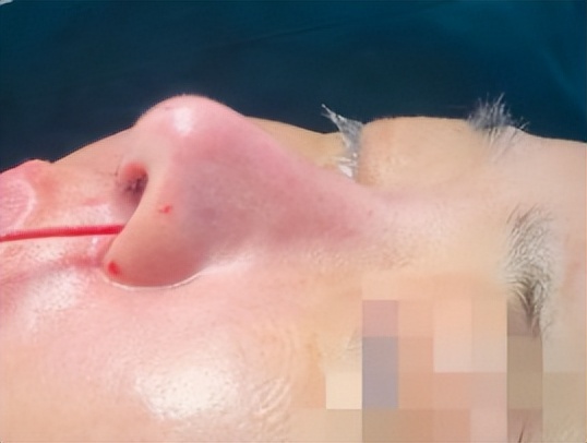 显老显凶怎么办,鼻子最丑三大鼻型怎么改变