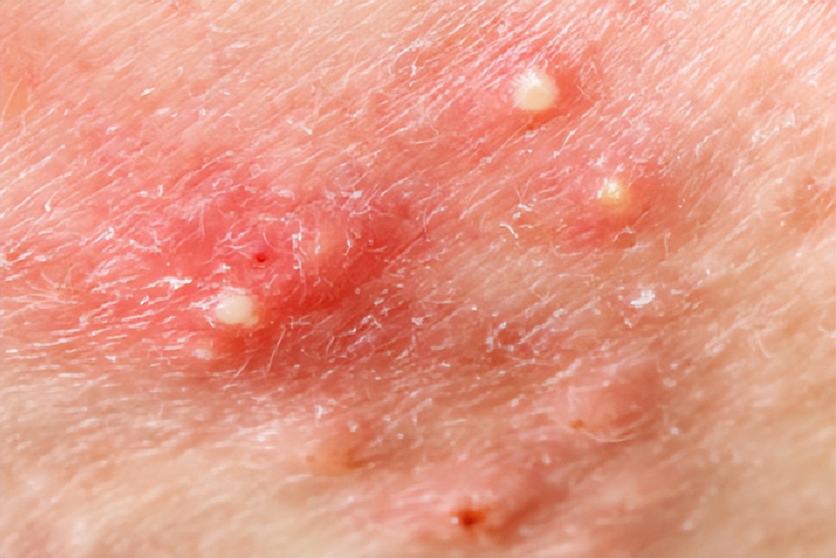 教你三天淡化痘印七天彻底祛除,怎样可以快速祛痘不留疤