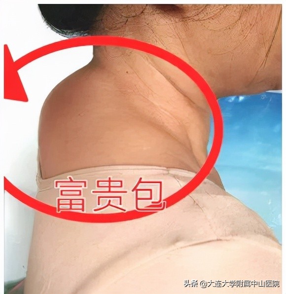 富贵包的专业知识快速消除方法,富贵包健康科普