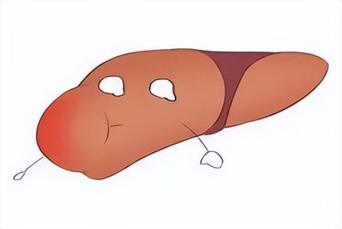 肝母细胞瘤有良恶之分吗,肝母细胞瘤罕见病