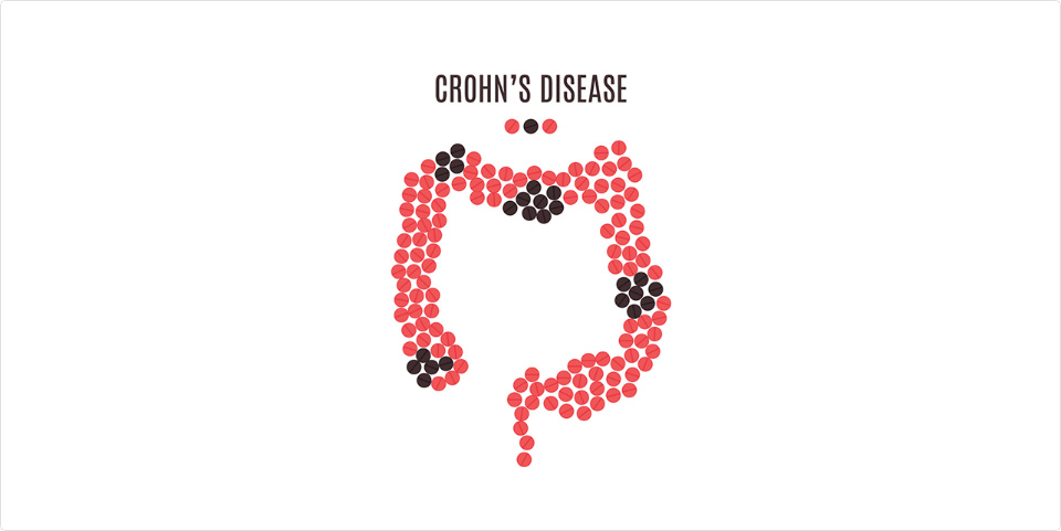 克罗恩病新药,克罗恩最新在研新药