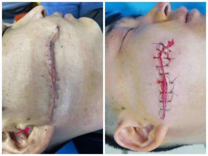 伤口做点阵激光治疗,点阵激光后怎么清理伤口