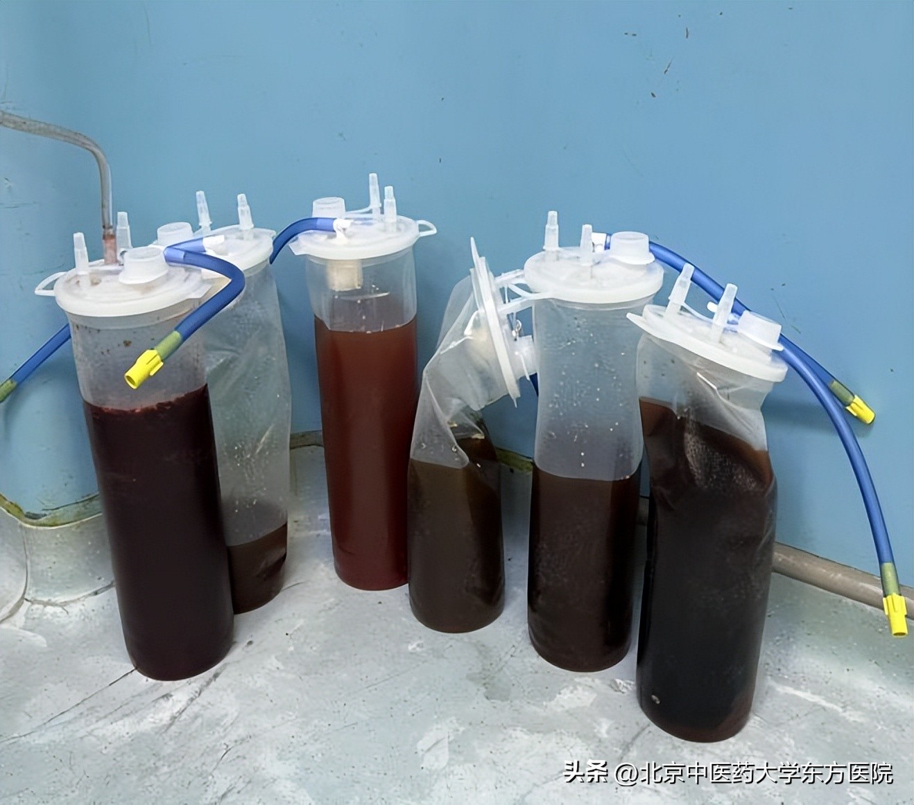 腹腔镜切除卵巢肿瘤,女子肚大似怀孕医生成功摘肿瘤