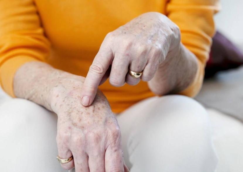 红霉素软膏能祛老人斑吗,老人身上长了老人斑为什么