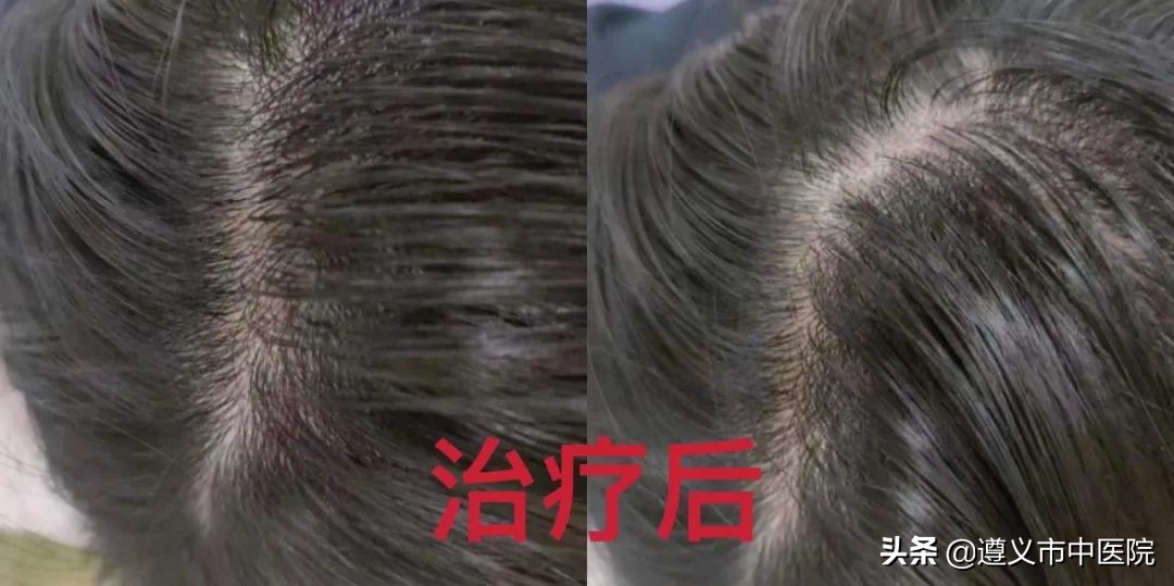 突发脱发秃了,脱发扩散