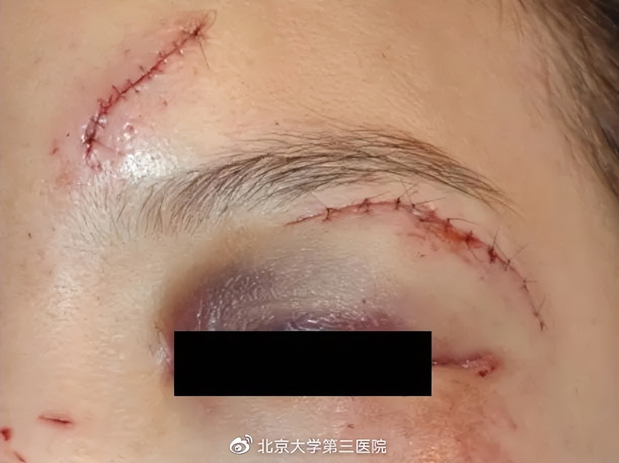 意外留疤怎么安慰,眉尾意外受伤留疤好不好