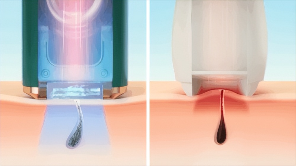 ulike脱毛仪脱女士唇毛,ulike脱毛仪真的能永久脱毛