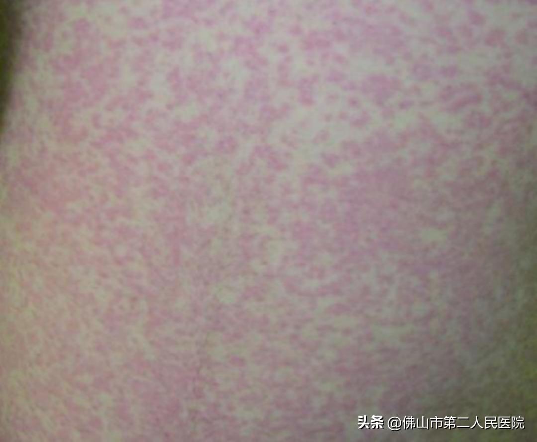 阳过之后皮疹怎么回事,阳了以后皮疹