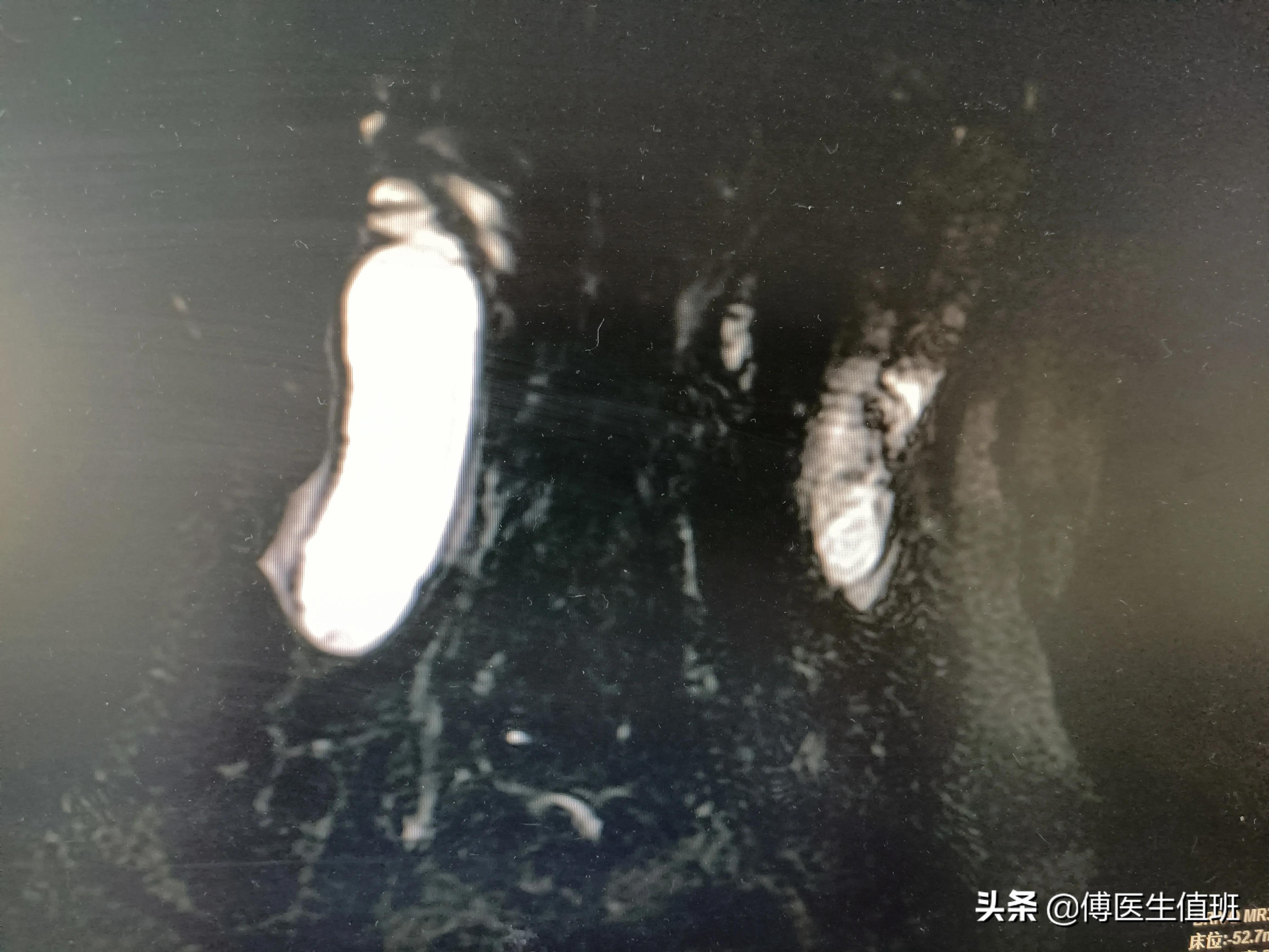 女子长期饭后腹胀,女子饭后常感腹胀误以为是胃病