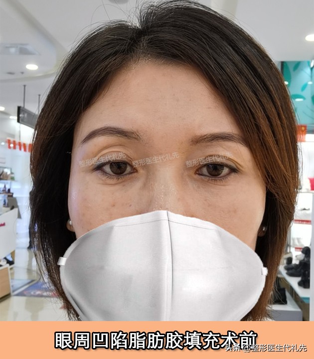 眼窝凹陷填充脂肪不成活怎么办,眼窝填充脂肪肿胀期眼睛睁不开