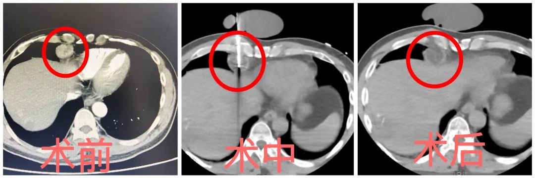 肝癌心脏转移,肝左叶巨块型肝癌微创手术
