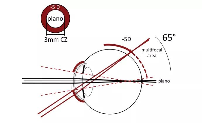 角膜塑形镜控制度数的原理是什么,角膜塑形镜控制近视度数增长