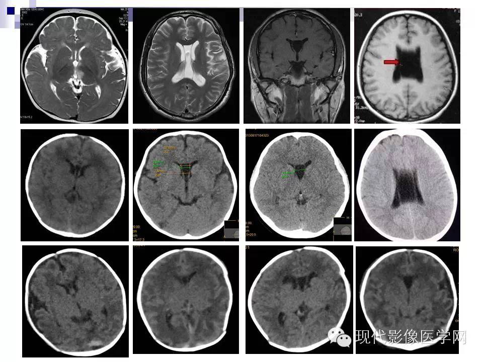 透明隔缺失影像学表现,透明隔腔影像