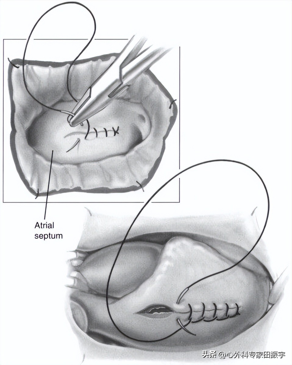 二尖瓣成形术,二尖瓣成形术后需要静养多久