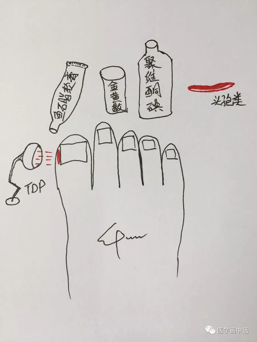 得了甲沟炎如何快速处理,甲沟炎怎么办教你一招解决