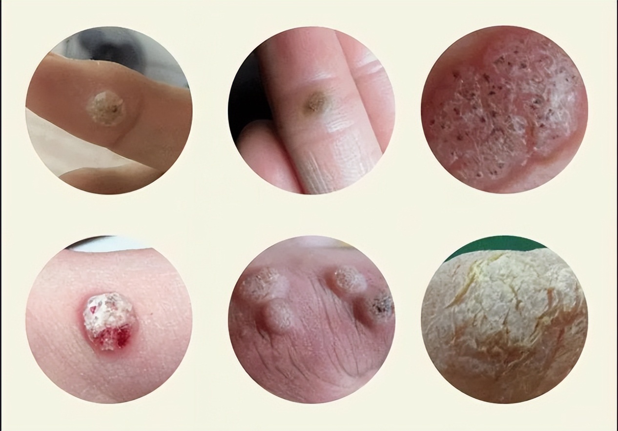 女性hpv十大常识,女性hpv常识大全