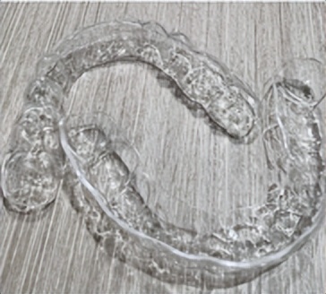 拔牙矫正后多长时间能合缝,拔牙矫正需要缝线吗