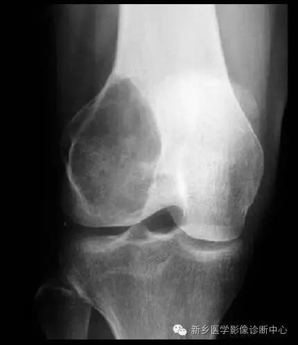 长骨膨胀性病变,长骨偏心性膨胀性病变