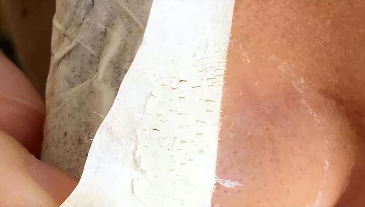 鼻子上有白白的小点可以挤吗,鼻子上黑黑的小点点怎么去除