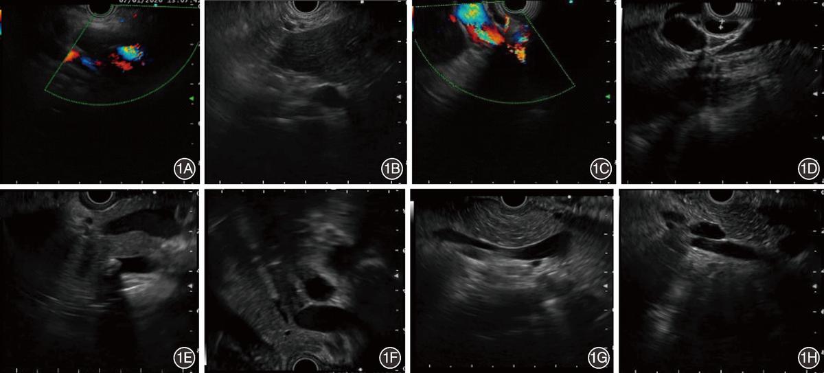 基于深度学习的内镜超声胆管扫查辅助分站系统构建