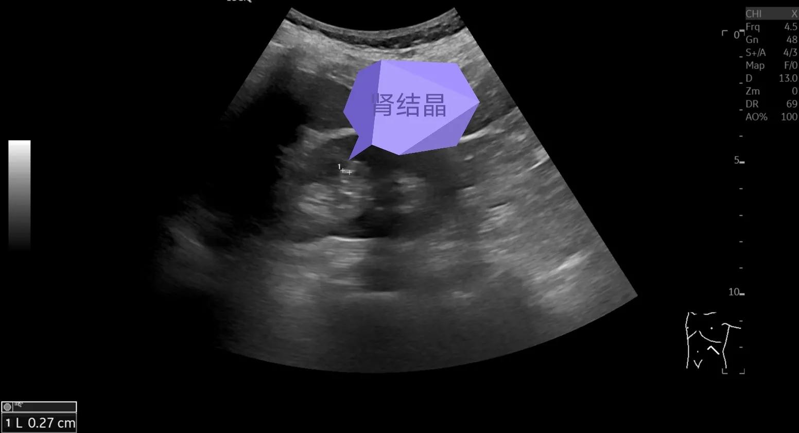 解读肾脏超声检查报告:肾结石、肾结晶、肾钙化灶到底什么关系?