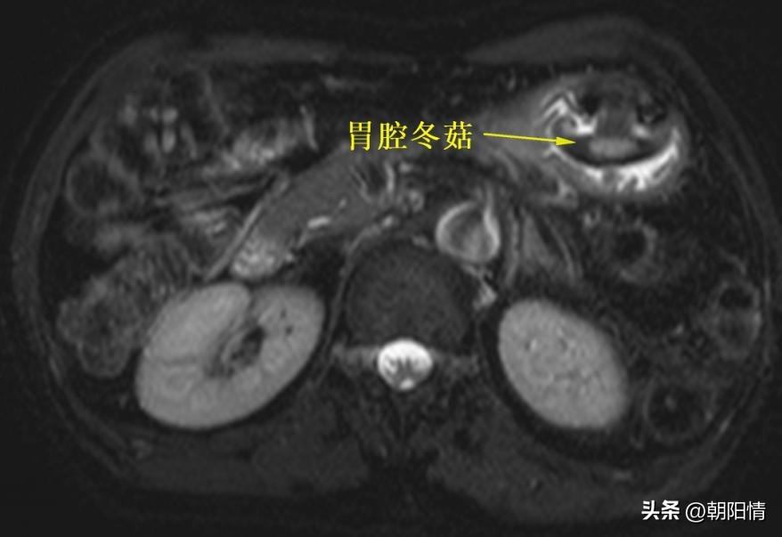 消化道异物中医诊断名称,消化道骨性异物