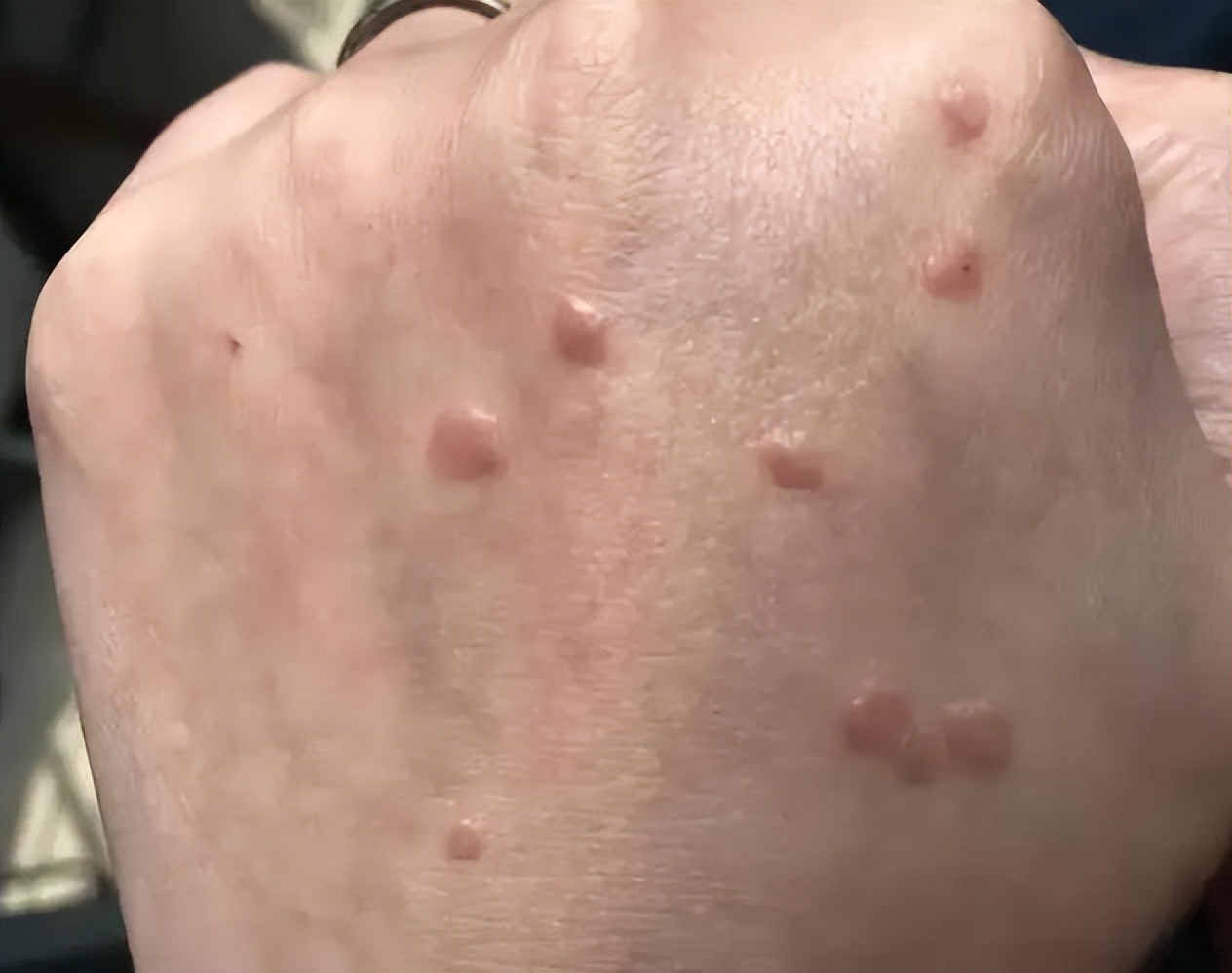 hpv感染严重皮肤会有什么表现,感染了hpv皮肤会出现哪些现象