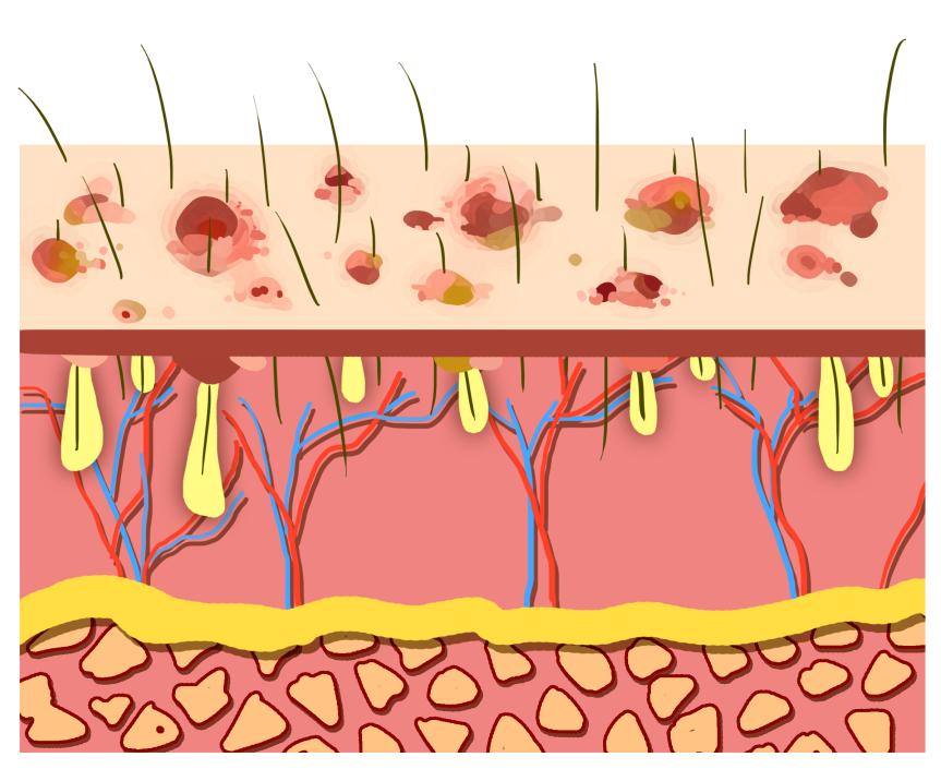 疱疹脱皮症状,疱疹脱皮后很痒怎么办